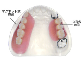 マグネット式義歯 従来の義歯