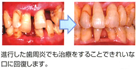 進行した歯周炎でも治療をすることできれいな口に回復します。